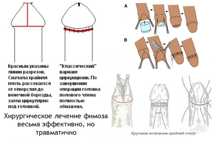 Как лечить фимоз