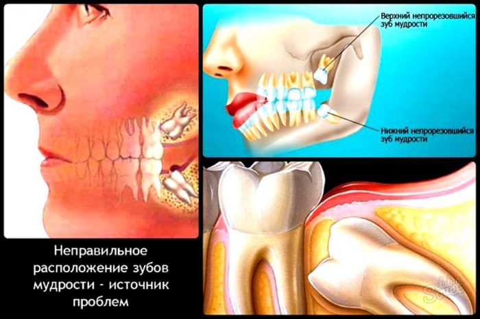 Нужно ли удалять зубы мудрости, если они не болят