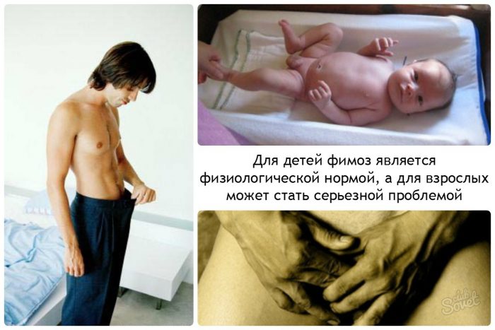 Как лечить фимоз
