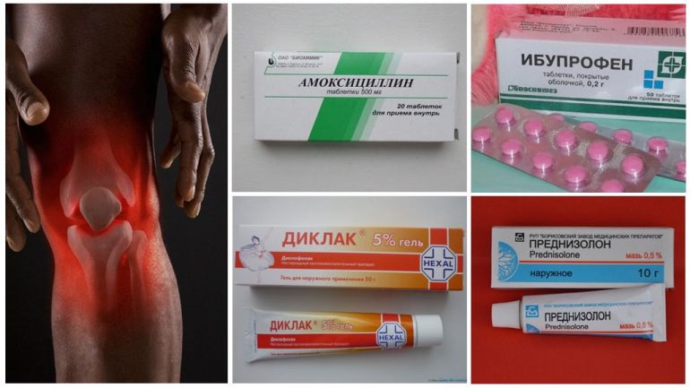 Як лікувати бурсит колінного суглоба в домашніх умовах Як лікувати бурсит колінного суглоба в домашніх умовах