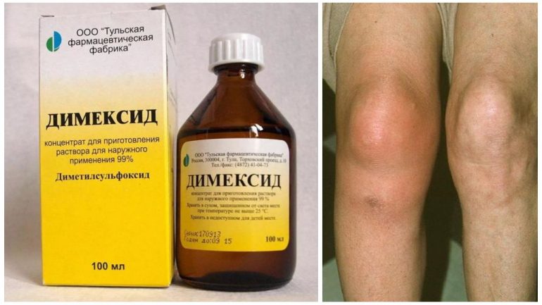 Медикаментозне лікування бурситу Медикаментозне лікування бурситу
