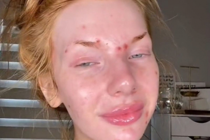 Блогерка з акне показала обличчя без фільтрів та здивувала вмілим макіяжем