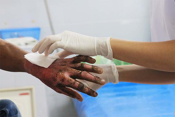 До чого сниться опік на руці, нозі чи обличчі — 50 тлумачень із різних сонників